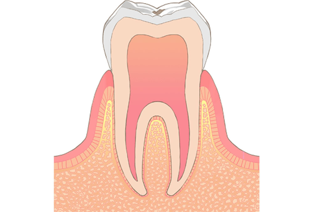 初期むし歯