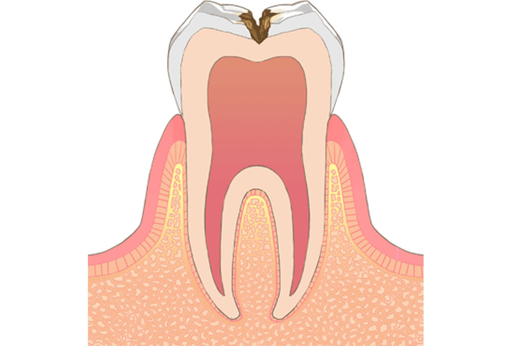 象牙質のむし歯