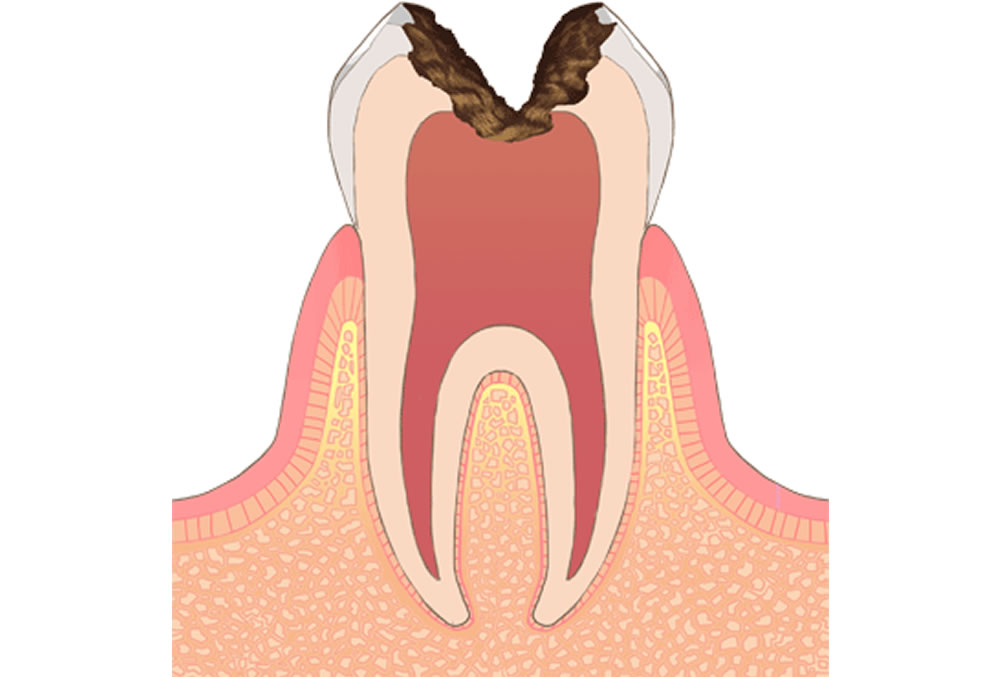 神経にまで進行したむし歯