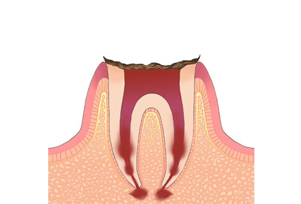 歯根だけが残存している状態のむし歯
