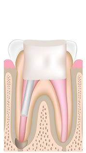 根管の封鎖