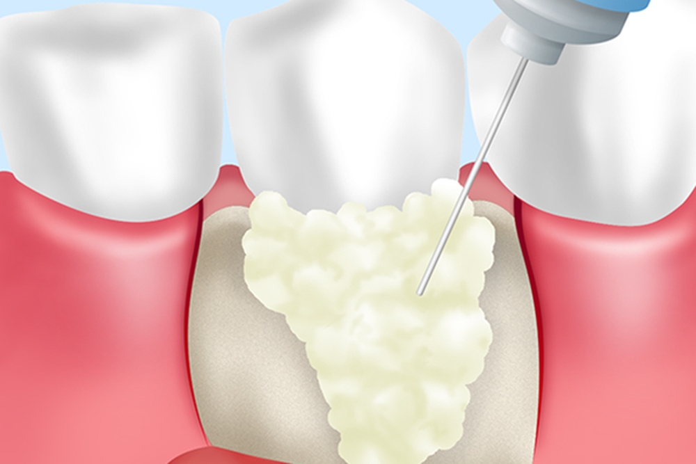 歯周組織再生療法（リグロス）